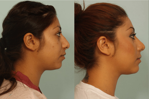 Chin Augmentation